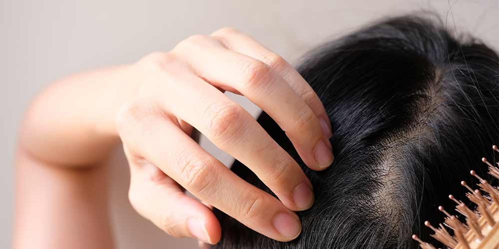 درمان ریزش مو بعد از کرونا